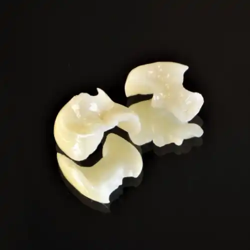 オールセラミックインレー