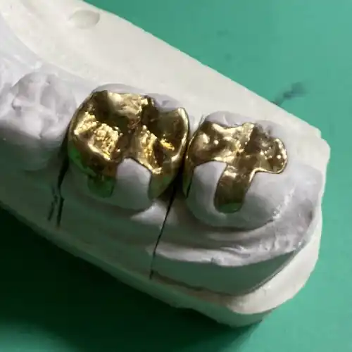 ゴールドインレー