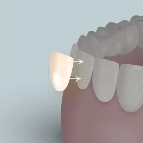 オールセラミックラミネートニベア